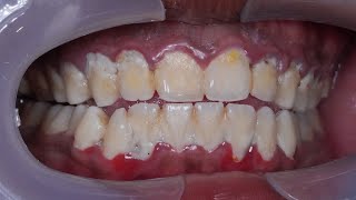 1 min edition: Scaling video | Dentist | Dokter Gigi Tri Putra
