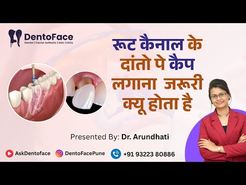 रूट कैनाल के दांतो पे कैप लगाना क्यू जरूरी होता है ? @AskDentoface-tc9xs  #rct