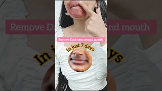 Get rid of pigmentation around the mouth #short #pigmentationsolution