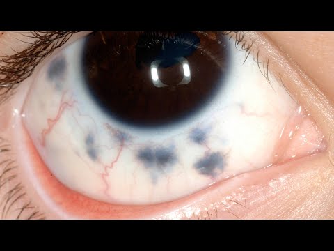 Pigmented Conjunctival Lesions  Dr  Ralph Eagle
