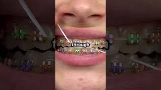 Flossing with braces #FlossingTips #BracesHygiene #OrthoHealth #CleanSmile #OrthodonticCare