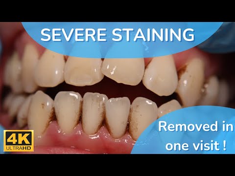 Amazing Results Stain and Tartar Removal Just in One Visit [20M Smoker]