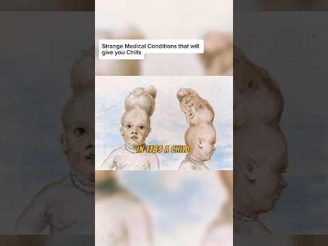 Tragic Story of the Two Headed Boy of Bengal #scary #mystery #shorts