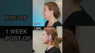 Only 1 Week Post-Surgery | Vertical Facelift #antiaging #beforeandafter #face