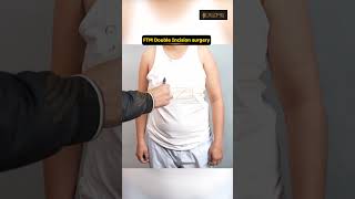 FTM Double Incision surgery