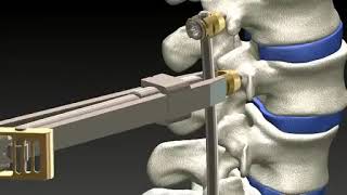 HumanTech: Venus Dorsale Fixation