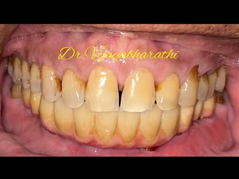 All on 4 & All on 6 - Implant supported fixed teeth