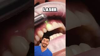 Dental Laser Explained !?