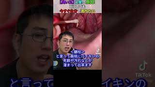 【臭い玉】口臭の原因！どうしても今すぐ自分で取りたい時の対処法