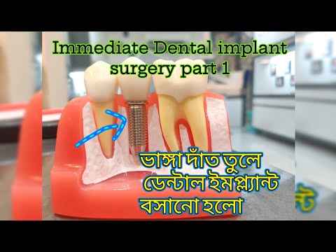 Step by step  Immediate Dental Implant surgery replacing broken tooth. Part-1 ডেন্টাল ইমপ্ল্যান্ট.