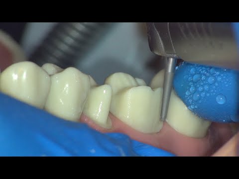 Crown Prep Tutorial | ACC 3, 4 | First Person Perspective