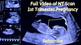 Baby Girl’s Ultrasound FULL VIDEO  NT Scan I 1st Trimester II 12 Weeks Pregnant