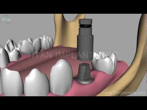 How to place and Restore Titan TG Post Abutment