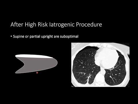 Managing Pneumothorax on Chest Radiographs