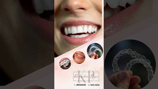 #dentist #dentalbraces #chennaidentist #dentistry #invisalign #invisalignsmile #instadentist #dental
