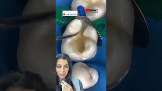 Dental filling procedure | dental filling video | Dr. Yazdan | dental filling between teeth