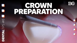 Two-plane preparation for a crown without undercuts