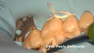Microscope Posterior Direct Restoration