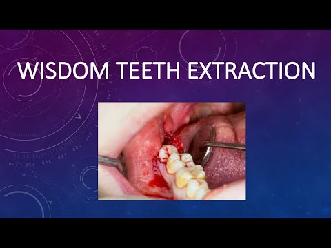 Wisdom teeth extraction 🦷❤️