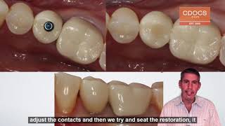 Tip of the Day: Screw Retained Crown