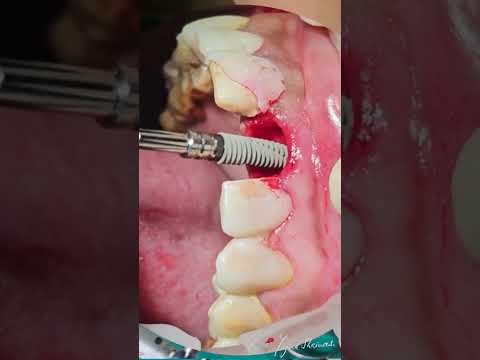Immediate placement of Dental Implant to replace  fractured tooth in Esthetic zone .
