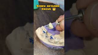 screw retained crown 👑 #dentist #smiledental #dental #smiledesigner #youtube #smiledesign#dentistry