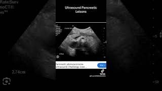 Pancreatic ultrasound