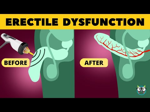 Shockwave therapy for Erectile Dysfunction / Erectile Dysfunction treatment (ED)