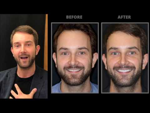 Transforming My Smile: Porcelain Veneers Experience