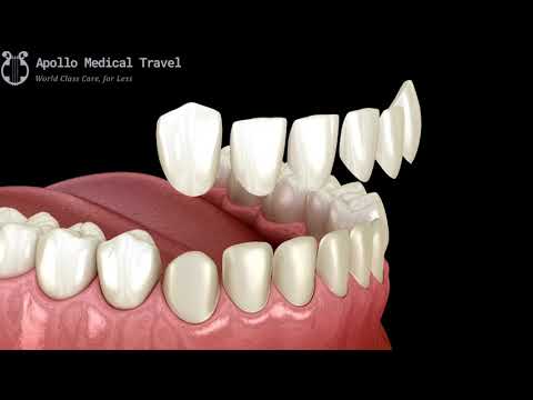Animated Veneers Procedure | Apollo Medical Travel
