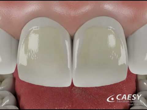 Damage from Soft Drinks