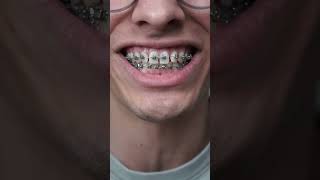 don't eat these 3 things with braces