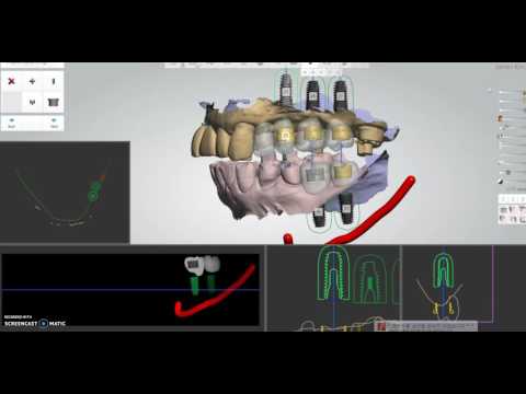 DDA Dio Implant Case Presentation
