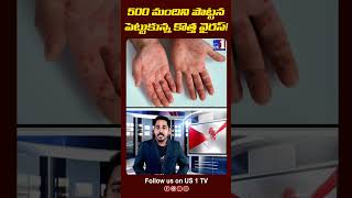 Monkeypox virus News | US 1 TV