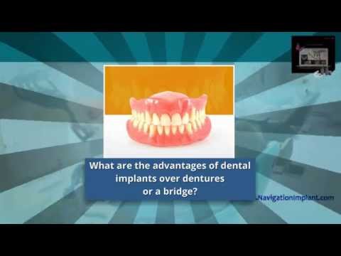 What are the advantages of dental implants over dentures or a bridge? (4/20)