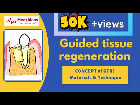 Guided Tissue Regeneration - Concept of GTR I Periodontal Regeneration l Mediklaas