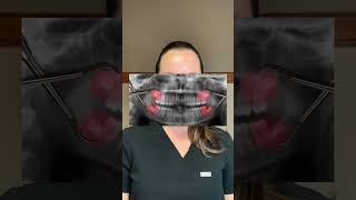 Should you get your wisdom teeth removed? #drwindhorst #choiceorthodontics #wisdomteeth