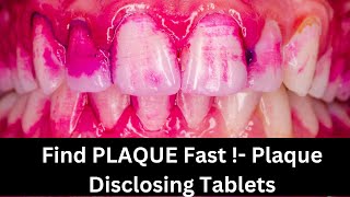 “Reveal Hidden Plaque in Seconds! (How to Use Plaque Disclosing Tablets)”