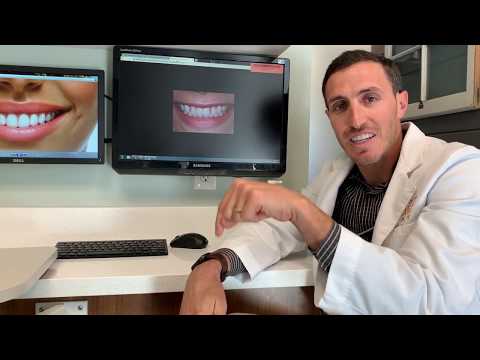 Why You Should Straighten Teeth Before Getting Veneers