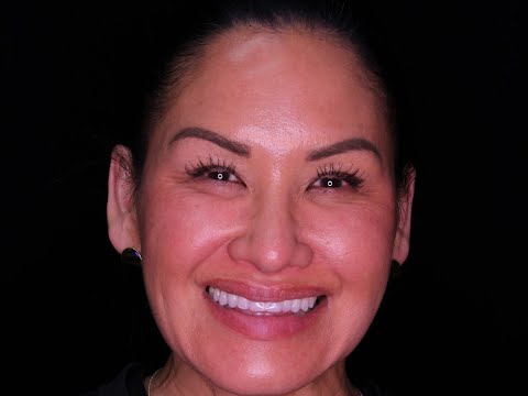 BioClear Diastema Closure Reveal