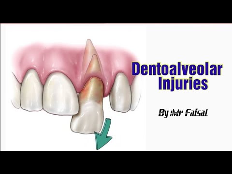 Dentoalveolar Injuries Part-1