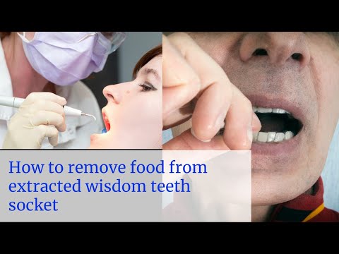how to remove food from extracted wisdom teeth sockets