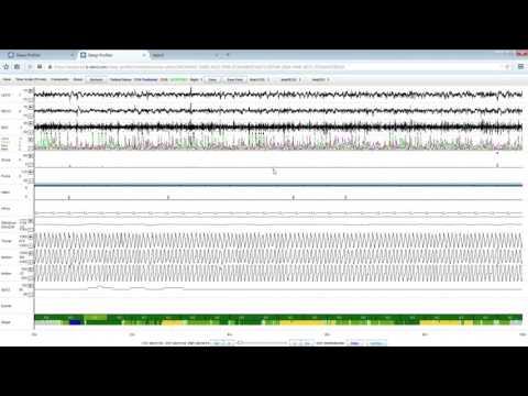 Assessment of Sleep and Sleep Disordered Breathing with PSG2