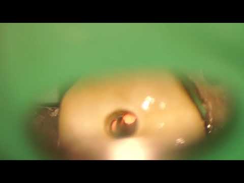Micro endodontics