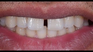 Diastema closure using Bioclear method