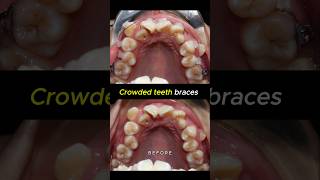 Crowded teeth braces transformation. 36 months time #orthodontist #braces #dentist