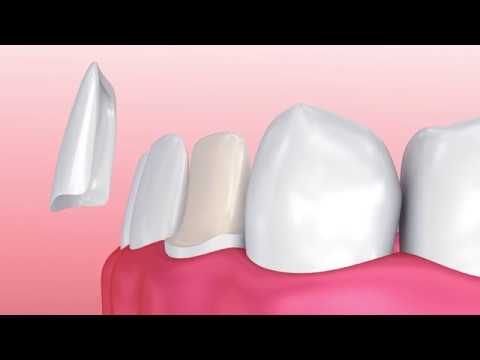 FAQ - What is a veneer and how long do they last? | Pelican Landing Dental | Bonita Springs Dentist
