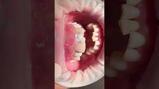 Flowable Composite Injection Technique #dentistry #restorativedentistry #prosthodontic #dental