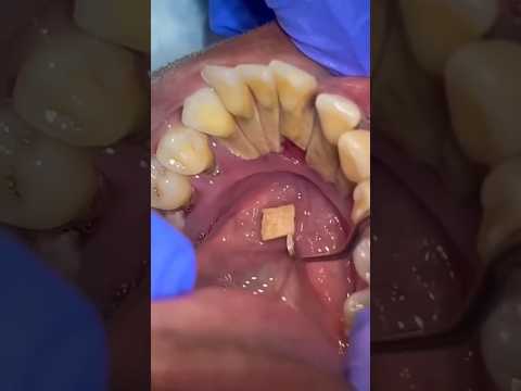 EXTREME TEETH BUILDUP CLEANING #brushyourteeth #dentalawareness #dentalhealth