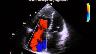 15. Severity of tricuspid regurgitation